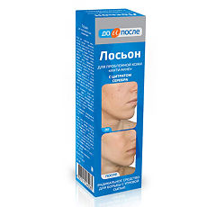 Изображение товара До и После Лосьон Анти-акне для проблемной кожи 200 мл 1 шт