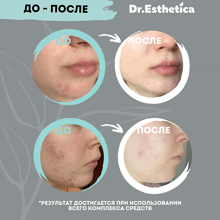 Dr. Esthetica\Доктор Эстетика No Acne Adults Маска для лица увлажняющая двухэтапная 3+10 г 1 шт